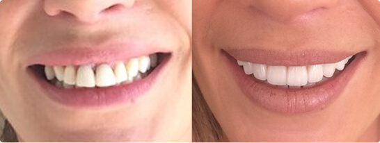 antes - despues Clínica Dentointegral