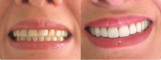antes - despues Clínica Dentointegral