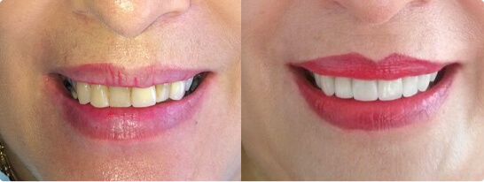 antes - despues Clínica Dentointegral