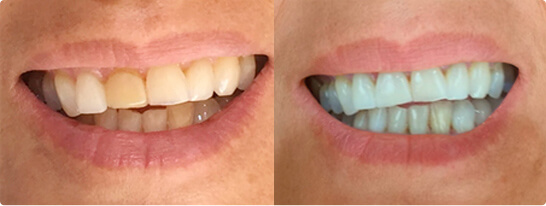 antes - despues Clínica Dentointegral